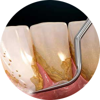 Periodoncia